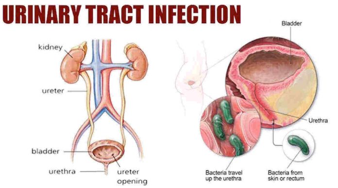 Urinary Track Infection