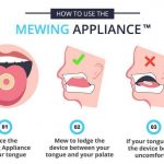 Mewing