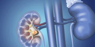 kidney-stones