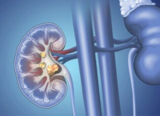 kidney-stones