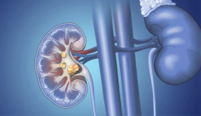 kidney-stones