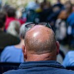 Premature Baldness