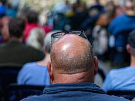 Premature Baldness